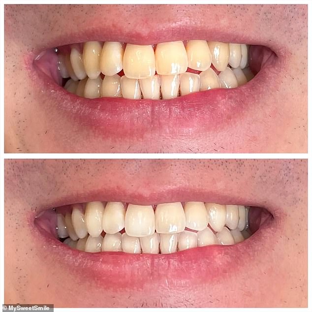 Simply place the smaller strip on the bottom teeth and the larger strip on the top teeth and let them work their magic for 30 minutes before rinsing off any residue left behind