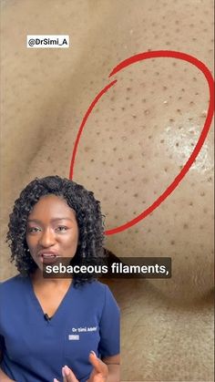 Black Dots on the Nose? Sebaceous Filaments & How To Get Rid Of Them + Products How To Get Rid Of A Bump On Your Nose, How To Get Rid Of Black Dots On Nose, Strawberry Nose Remedy, How To Get Rid Of Strawberry Nose, Sebaceous Filaments Skincare, Sebatious Filaments, How To Get Rid Of Black Heads On Nose, How To Get Rid Of Redness From Pimples, How To Get Rid Of Sebaceous Filaments