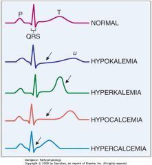 Nursing Infographic, Electrolyte Imbalance, Paramedic School, Nursing Mnemonics, Medicine Student