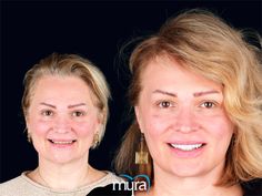 Nina Jeltekova traveled to Turkey to transform her smile with 14 Osstem implants, 4cc bone grafting, 1 sinus lift, 2 implant extractions, 2 temporary dentures, and 28 zirconium crowns. The result? A confident, beautiful smile she loves! 😊
Ready to start your own smile journey? Contact us today for a FREE Consultation!
📞 +90 543 938 33 50
🌐 www.myradental.co.uk
#SmileJourney #DentalImplants #ZirconiumCrowns #TeethTurkey #MyraDentalCentre