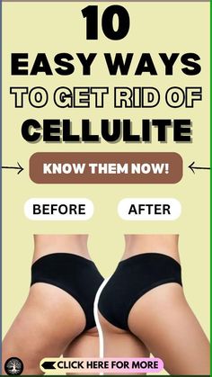 10 Ways To Get Rid Of Cellulite Fast: Cellulite is commonly seen on the thighs, buttocks, hips, and abdomen, and it can make you conscious and hide your beauty behind long pants and tops. Thankfully, there are some effective ways to get rid of cellulite. #cellulite #beauty #beautytips #skincare Laser Stretch Mark Removal, Skin Glow Tips, Skin Care Solutions, Flexibility Workout, Anti Aging Skin Products, Workout Challenge, Long Pants, Tips And Tricks, Skin Care Tips