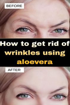 Discover an effective at-home remedy to reduce wrinkles and dark spots in this comprehensive guide. Learn about simple ingredients, application methods, and tips for enhancing your skincare routine. Achieve a more youthful and radiant complexion effortlessly with this easy solution! Get Rid Of Wrinkles, Erase Wrinkles, Best Skin Care Routine, Deep Skin, Remove Dark Spots, Deep Wrinkles, Prevent Wrinkles