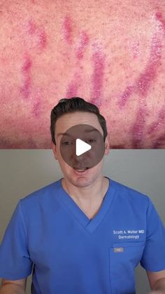 Scott Walter, MD, FAAD on Instagram: "A dermatologist guide to stretch marks: the best remedy that actually has evidence behind it. 

#stretchmarks #stretchmarkremedy #pregnancy #pregnancytips #whatsonmyskin #howto #homeremedy #dermatologist #striae #creatorsearchinsights #stretchmark" Stretch Mark Remedies, Walter Scott, Pregnancy Tips, Home Remedies, The Creator