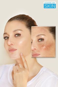 How long does it take for Admire skin to work? Skin Peeling On Face, Oily Skin Remedy, Skin Peel, Blackhead Remedies, Facial Anatomy, Pimples Overnight, Cosmetic Clinic, Facial Peel, Acne Scar Removal