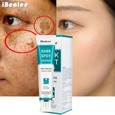 Freckle Cream, Dark Spot Remover, Acne Dark Spots, Spot Remover, Freckle Face, Blackhead Removal, Whitening Face, Professional Skin Care Products, Brightening Cream