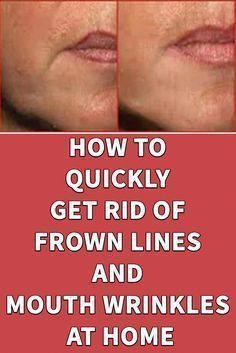 How to quickly get rid of frown lines and mouth wrinkles at home For USA US United States.#wrinkle #wrinkleremover #wrinklesremediesface #wrinkles #wrinklesaroundmouth #wrinklearoundmouth #wrinkletreatment #howtogetridofrinkles #HOWTOREMOVEWRIKLE #wrinklecream #USA #UNITEDSTATES Frown Lines Around Mouth, Lines Around Mouth, Mouth Wrinkles, Frown Lines, Facial Tips