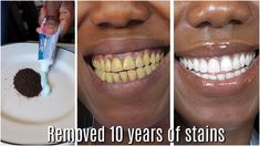 Teeth Routine, Rice Shampoo, Baking Soda Teeth, Natural Teeth Whitening Diy, Baking Soda Teeth Whitening, Teeth Whitening Homemade, Whitening Teeth, Teeth Whitening Remedies, Teeth Whitening Diy