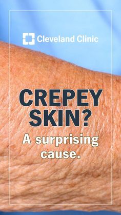 Crepy Skin, Crepe Skin, Creepy Skin, Saggy Skin, Cleveland Clinic, Summer Dresses For Wedding Guest, Skin Remedies