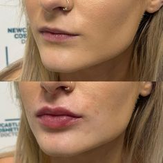 Before And After Lip Fillers Small Lips, Lip Filler Smile Before And After, Lip Flip And Filler Before And After, Small Lip Injections, Lip Filler On Small Mouth, Volbella Lips Before And After, Lip Injections Before And After 0.5ml