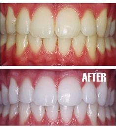 Put a tiny bit of toothpaste into a small cup, mix in one teaspoon baking soda plus one teaspoon of hydrogen peroxide, and half a teaspoon water. Thoroughly mix then brush your teeth for two minutes. Remember to do it once a week until you have reached the results you want. Once your teeth are good and white, limit yourself to using the whitening treatment once every month or two. Obličejové Masky, Tooth Whitening, Makeup Tip, Brush Your Teeth, Periodontal Disease, Oil Pulling, Hydrogen Peroxide