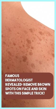 Sun Spots On Skin, Warts On Hands, Brown Age Spots, Skin Moles, Get Rid Of Warts