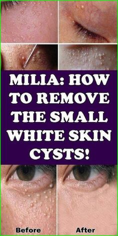 Milia: How To Remove The Small White Skin Cysts? Under The Skin, White Skin, Healthy Skin Care, Health And Beauty Tips, Health Facts, Health Remedies, The Skin, Keratin, Skin Cells