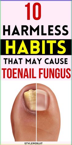 Fungal toenail infections, medically known as onychomycosis, can be uncomfortable and unsightly. The Thick Toenail Remedy, Fungal Infection Remedies, Toenail Fungal Infection, Nail Remedies, Nail Fungus Remedy, Nail Infection, Fungal Nail, Ingrown Toe Nail, Nail Oil