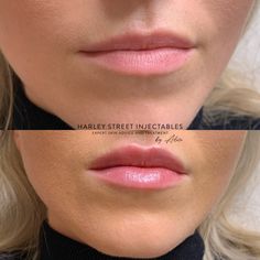 Lip Filler For Hydration, Small Lip Injections, .5ml Lip Filler, .5ml Vs 1ml Lip Filler, Natural Lip Fillers Small Lips, Light Lip Filler, Natural Looking Lip Fillers, Subtle Lip Filler Before And After