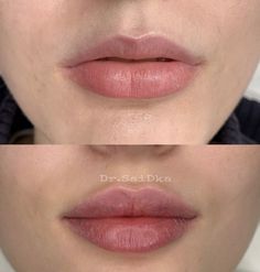 @dr.saidka instagram визуал косметолога увеличение губ 1ml Lip Filler, Face Plastic Surgery, Derma Fillers, Plastic Surgery Fail, Heart Shaped Lips, Plastic Surgery Gone Wrong, Face Surgery