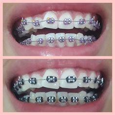 Braces First Day, Black Braces Teeth, Braces Color Combos, Brackets Aesthetic, Brackets Ideas, Braces Colors Combinations, Damon Braces, Braces And Glasses, Braces Bands