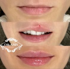 Lip Filler For Uneven Lips, One Syringe Lip Filler, Lip Filler Small Mouth, Lip Filler Inspiration Small Lips, Natural Lip Fillers 0.5ml, Lip Filler On Small Lips, Armonizacion Facial, Natural Lip Fillers, Lip Filler Before And After