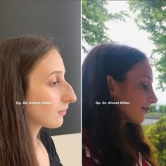 Models With Big Noses, Nose Surgery Rhinoplasty, Rhinoplasty Surgery, Facial Fillers, Jewish Girl, Nose Surgery, Nose Job