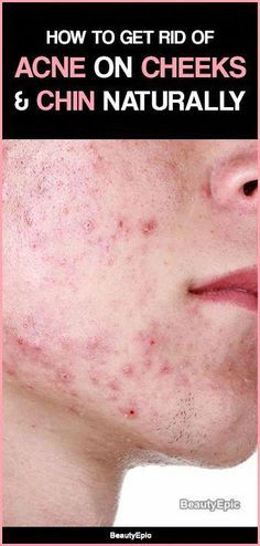 How To Get Rid Of Acne, Healthy Habits, Acne, Beauty