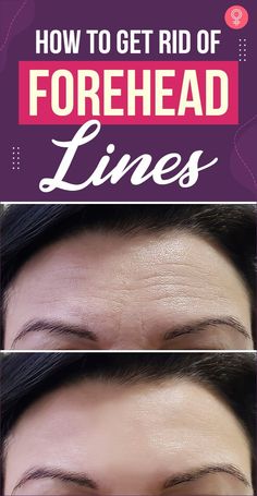 Natural Ways To Reduce Wrinkles, Fine Line Remedies, How To Get Rid Of Deep Forehead Wrinkles, How To Stop Forehead Wrinkles, Get Rid Of Deep Forehead Wrinkles, How To Get Rid Of Lines On Forehead, How To Get Rid Of Fine Lines On Face, How To Get Rid Of Forehead Wrinkles Naturally, How To Relax Forehead Muscles