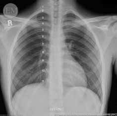 an x - ray shows the chest and ribs