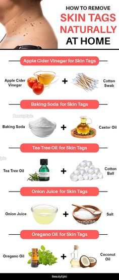 Baking Soda For Skin, Juice For Skin, Ancient Remedies, Remove Skin Tags, Apple Cider Vinegar For Skin, Remove Skin Tags Naturally, Onion Juice, Common Knowledge