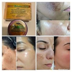 Hyperpigmentation Mask, K Tape, Dark Spots On Face, Skin Lightening Cream, Brown Spots Removal, Skin Tags, Lightening Creams, Spots On Face, Sunscreen Spf 50