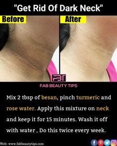 How To Clean Dark Neck, Dark Neck Remedies Fast, Dark Neck Remedies, Dark Neck, Clear Skin Fast, Beginner Skin Care Routine, Face Skin Care Routine, Natural Skin Care Remedies, Diy Skin Care Routine