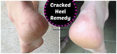 Cracked Heel Remedy –  Summertime is here! Cracked Heel Remedy, Cracked Heel Remedies, Heel Repair, Cracked Heel, Satin Hands, Foot Soak, Cracked Heels, Pumice Stone