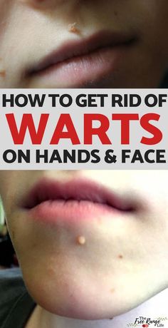 Warts can be painful and embarrassing to deal with.Learn how to get rid of warts naturally- works on faces, hands, feet and is safe enough for kids! How To Remove Warts, Weight Changes, Natural Cough Remedies, Layers Of Skin