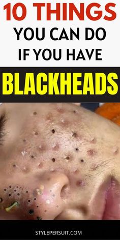 Blackhead Remedies, Blackheads On Nose, Blackheads Removal, Homecoming Makeup Browneyes, Hoco Makeup, Makeup Looks For Brown Eyes