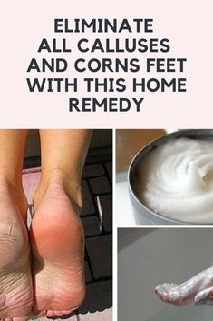 Get Rid Of Corns, Vicks Vaporub Uses, Corn Seed, Pedicure At Home, Foot Health, The Glory