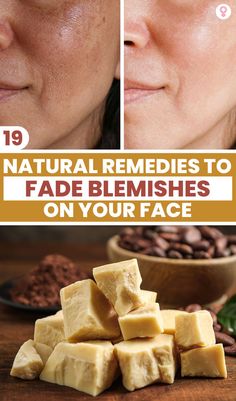 Hiding your blemishes with makeup is not a permanent solution. To help you get rid of blemishes permanently, we have compiled a list of ingredients that you can easily find in your kitchen and use without any apprehensions about side effects. #skin #skincare #glowskin #bodyscrubs #skincaretips #healthyskin Blemishes On Face, Wrinkles Remedies Face, Calamine Lotion, Potato Juice, Blemish Remover, Face Makeup Tips, Beauty Tips For Glowing Skin, Perfect Skin Care Routine, Skin Blemishes