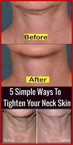 Discover 5 simple and natural wrinkle remedies to tighten your neck skin quickly! These effective anti-aging tips help fade wrinkles under eyes, around the mouth, and on hands. Achieve a glowing complexion and remove signs of aging fast with our skin care solutions. Embrace a youthful look with these wrinkle solutions that work! Perfect for anyone looking to enhance their natural beauty and remove wrinkles naturally. #Skincare #AntiAging #NaturalBeauty #WrinkleRemedies #GlowingSkin Loose Neck Skin, Natural Wrinkle Remedies, Tighten Neck Skin, Chest Wrinkles, Neck Tightening, Chin Exercises, Wrinkle Remedies, Tighten Loose Skin, Neck Exercises