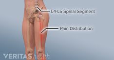 L4 And L5 Spine, L4 L5 Back Pain Relief, Stenosis Exercises, Hip Health, Spinal Fusion, Skeleton Anatomy, Hip Problems