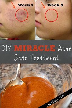 DIY Acne Scar Treatment. | acne remedies | | acne scars | | acne treatment | #acneremedies #acnescars #acnetreatment Doterra Acne, Scar Remedies, Brown Spots On Skin, Diy Acne, Natural Acne Remedies, Brown Spots Removal, Natural Acne, Brown Spots On Face, Acne Scar