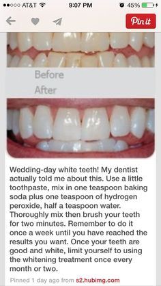 Whiten Teeth With Baking Soda, Baking Soda Teeth, Baking Soda Teeth Whitening, Teeth Whitening Homemade, Teeth Whitening Remedies, Teeth Whitening Diy, Charcoal Teeth Whitening, Whiten Teeth, Diy Products