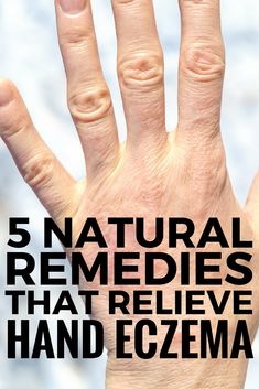 5 Natural Hand Eczema Remedies that Work! There are different types of hand eczema, and the causes can vary from person to person, but on thing is certain: itchy, red, raw, weeping, and dry skin can be pretty miseral. Check out our best tips and natural products that help treat and prevent hand eczema in the winter and beyond and say YES to beautiful skin! #eczema #psoriasis #itchy #skin #dermatitis #remedies #naturalremedies #handeczema Get Rid Of Warts, Skin Disorders, Itchy Skin, Natural Remedies, Michigan, Lotion, Cream, Skin