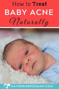 a baby laying on its back with the words how to treat baby acne naturally