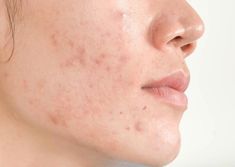 Are over-the-counter acne treatments not working for your skin? Try Chinese herbal remedies from Plum Dragon Herbs for a natural solution to persistent acne. Demodex Mites, Pimples Under The Skin, Diy Acne, Natural Acne Remedies, Types Of Acne, How To Get Rid Of Pimples, Acne Causes, Acne Breakout, Acne Remedies