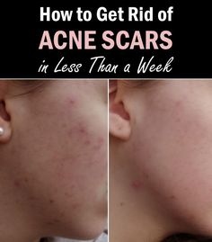 How to Get Rid of Acne Scars in Less Than a Week #AcneScars Forehead Acne, Acne Overnight, Get Rid Of Acne, Rid Of Acne, Home Remedies For Acne, Hormonal Acne