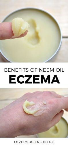 Neem oil for Eczema: Practitoners of Ayurvedic medicine use Neem oil for Eczema and many other skin issues. Learn how it works to treat the symptoms of eczema including redness, itchiness, and irritation #neemoil #eczema #eczemacream #naturaleczemacream #neem #ayurvedic #dermatitis #psoriasiscream Benefits Of Neem Oil, Benefits Of Neem, Natural Anti Aging Skin Care, Coconut Oil Uses, Natural Anti Aging, Neem Oil, Ayurvedic Medicine, Skin Care Recipes