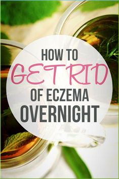 How To Get Rid Of Eczema Overnight - Easy Home Remedies To Get Rid Of Eczema Overnight. Learn how to get rid of eczema fast with natural eczema treatment and natural home remedies. Eczema is atopic dermatitis which is inflammation of the skin it causes the skin to become rough and inflamed with blisters that cause itching and bleeding. Exema Treatments Natural, Get Rid Of Excema, How To Get Rid Of Excema, Exema Treatments Diy, Excema Remedies, Overnight Remedies, Homemade Scrubs, Ear Problems, Healthy Natural Hair Growth