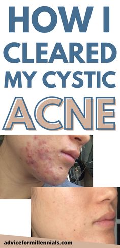 Acne Skincare Routine