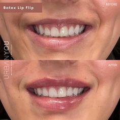 Botox Lip Flip | Before and After Face Injections, Lemon Face Mask, Sick Remedies, Skincare Products Photography, Lip Filler