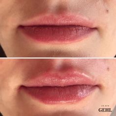 before and after photos of lip fillers on the upper lip, from top to bottom