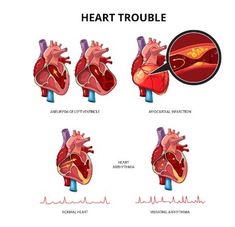 Heart Infographic, Body Anatomy Organs, Information Illustration, Cardiogenic Shock, Human Heart Anatomy, Human Body Organs, Medical Pictures, Normal Heart, Human Icon