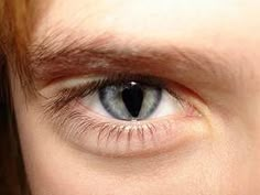 Coloboma Iris, Broken Iris Eye, Broken Iris, Iris Eye, Visual Impairment, Eye Parts, Parts Of The Eye, Eyes Beautiful, Low Vision