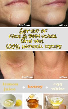 Fixings: – 4 tsp lemon juice – 4 tsp honey – 1 egg white Direction: – Add all fixings in a dish and blend them well – After blending all fixings, scar evacuation cream is prepared for use – Apply the cream straightforwardly on the scars and depart on for 20 minutes – After 20 … Obličejové Masky, Resep Diet Sehat, Beauty Remedies, Acne Remedies, Skin Remedies, Beauty Recipe, Diy Skin, Health And Beauty Tips, Beauty Treatments