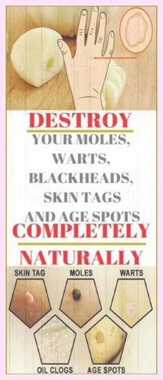 Destroy Your Moles, Warts, Blackheads, Skin Tags and Age Spots Completely Naturally Natural Wart Remedies, Fresh Aloe Vera Gel, Natural Healing Remedies, Natural Therapy, Hormone Imbalance, Skin Issues